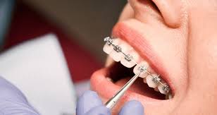 One option is to use clear aligners, like invisalign. What Does Brace Tightening Do The Orthodontists