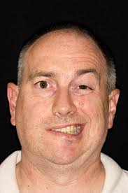 Image result for bell's palsy