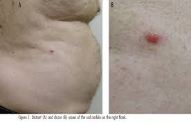 Image result for Nodule