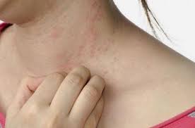 Psoriasis symptoms may look like raised, scaly patches on the skin. Pin Em Pele