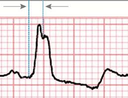 Image result for Left Bundle Branch Block