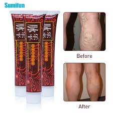 Crema Para El Tratamiento De Las Venas Varicosas Pomada Para Alivio Del Dolor De Pierna Arana Parche De Eliminacion De Angitis De Yeso Medico 3 Uds Parches Aliexpress