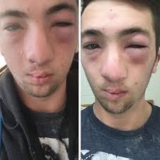 Brain Fog and Inattention Common For Those With Celiac Disease