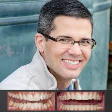 MEET BRIAN Before and After Photos Reno NV