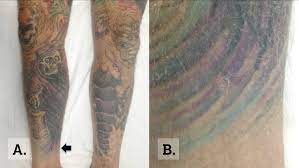 How skin cancer is diagnosed. Racgp Diagnostic Difficulties In Skin Cancer Detection Within Tattoos