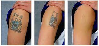 Kimyasal Peeling Dovme Silme Kremi Kotu Dovmeler Dovme Tattoo