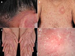 Image result for skin rash similar to scabies