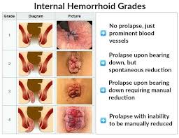 Image result for Hemorrhoid