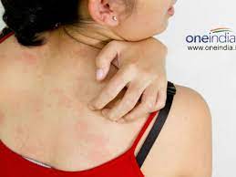 How To Treat Scabies During Pregnancy Boldsky Com