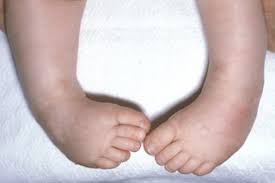 In most cases, clubfoot twists the front of the foot downward and inward, increasing the arch and turning the heel inward. Club Foot Nhs
