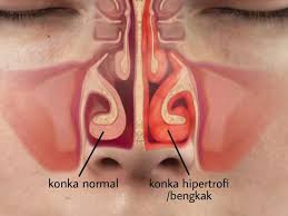 Oleh karenanya, anda harus peka untuk melihat gejala datangnya penyakit pada perut tersebut. Konka Hidung Membengkak Mungkin Itu Penyebab Hidung Sering Tersumbat Health Liputan6 Com
