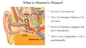 Meniere S Disease Vertigo Expert
