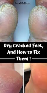 Dry Cracked Feet And How To Fix Them Health Remedies Invitations