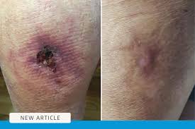 Image result for Calciphylaxis