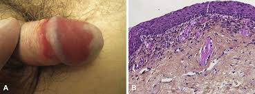Image result for Balanitis