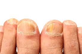 Image result for Yellow nail syndrome feet