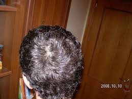 Le manifestazioni dell'alopecia androgenetica risultano diverse nei due sessi. 17 Anni Caduta Capelli Aiuto Chiedi All Esperto Salusmaster