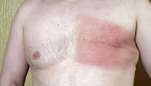 Because men generally have small amounts of breast tissue, it is easier to feel a small lump. Ultimate Medical Guide To Male Breast Cancer Twav Baby