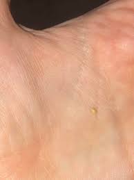 A pubic hair may, sometimes, get coiled as it grows, to enter back into the skin. How To Pop An Ingrown Hair In Your Pubic Area