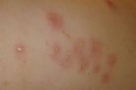 Image result for scabies effects on the human body