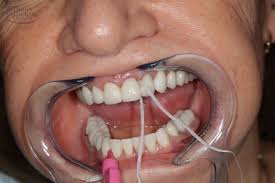 Unfortunately this is where most periodontal disease starts, so it is critical to remove plaque from these areas. Using Super Floss Subadental