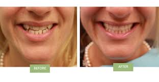 In a normal jawline, the upper teeth fit just over the lower teeth. Invisalign For Underbite Can Invisalign Fix Underbite
