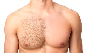 pros and cons of men s laser hair removal