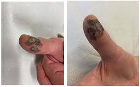 Image result for Acral lentiginous melanoma nail