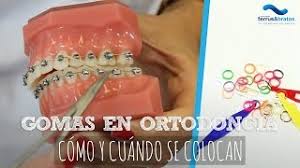 Maybe you would like to learn more about one of these? Gomas Ortodoncia Como Y Cuando Se Colocan Youtube