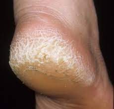 Mash A Banana And Apply It Over The Cracked And Dry Heels You Should Leave The Mash On For About Ten To Fifteen Minute Feet Care Home Remedies Beauty Remedies