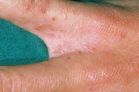 Scabies is an itchy skin condition caused by a tiny burrowing mite called sarcoptes scabiei. Scabies Pictures Of Rash Mites Symptoms Treatment