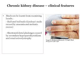 Functional proteinuria observed in subjects without renal diseases, has transitory character, does not exceeds 1 g/24h, and are not accompanied by the other urine abnormalities. Chronic Kidney Disease And The Benefits Of Early Detection Dr T A L Dlamini Specialist Physician And Nephrologist Ppt Download