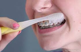 Brush all around the brace on each tooth, and then place your toothbrush directly on the brace to make sure that there is nothing stuck in it. Brushing Flossing With Braces Sun Orthodontics San Diego California