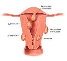 14 weeks pregnant uterus size. Understanding Uterine Fibroid Size How Big Is Too Big