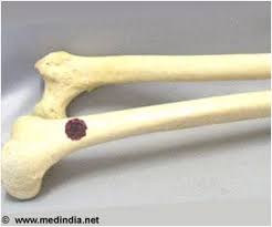 Primary bone tumors, which form from bone tissue and can be malignant (cancerous) or benign (not cancerous), and metastatic tumors (tumors that develop from cancer. Bone Cancer Victim Receives World S First Ever Titanium Pelvis Transplant
