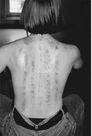 Gua sha was originally used for two conditions: Was Ist Gua Sha Fa Und Was Bringt Es Naturmed Fachbuch Blog