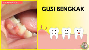 Gusi bengkak adalah salah satu gejala dari gingivitis kronis atau peradangan gusi kronis. Io Glajbkidr5m