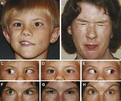 Familial complete androgen insensitivity syndrome (morris syndrome or testicular hârza m., sinescu i. Diagnostic Distinctions And Genetic Analysis Of Patients Diagnosed With Moebius Syndrome Ophthalmology