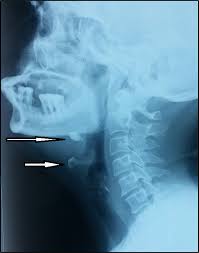 Image result for Sialolithiasis