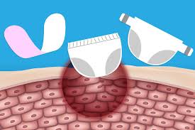 Image result for diaper dermatitis adult -children -infant -baby