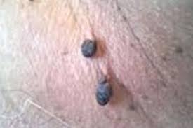 Fibreuse, à peine irriguée, elle s'est détachée du petit bout de peau un peu comme un corps étranger. Boules De Chair L Origine 5 Plus Dimanche