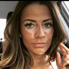 Black And White Skin Condition Model After Years Of Covering Up Her Skin This Model With Vitiligo Is Revealing Her Natural Beauty In 2020 Vitiligo Treatment Vitiligo Vitiligo Skin