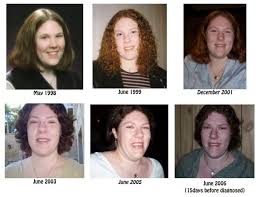 Image result for Acromegaly