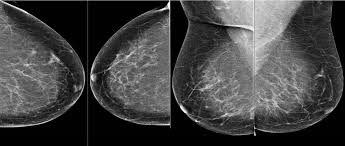 A dense breast has relatively less fat and more glandular and connective tissue. International Evaluation Of An Ai System For Breast Cancer Screening Deepmind