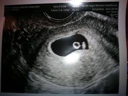 The baby has not yet fully formed limbs, small eyes, which at this due to progesterone production, the uterus is notreduces, providing a normal pregnancy. 6 Week Ultrasound Ultrasound Fake Ultrasound Ultrasound Pictures