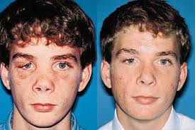 Post-Traumatic Deformities
