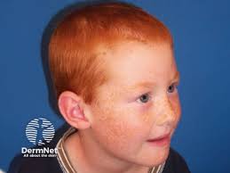 Image result for Freckled skin