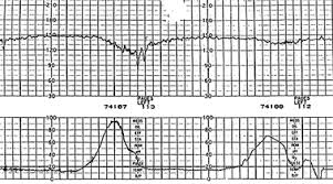 Image result for Late Deceleration