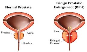 Maybe you would like to learn more about one of these? Benign Prostatic Hyperplasia Bph Southwest Urology