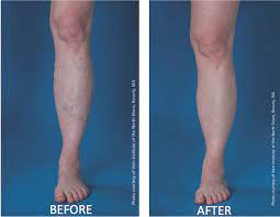 Pin On Tired Of Living With Leg Pain